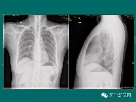 【PPT】膈肌膨出症影像学表现