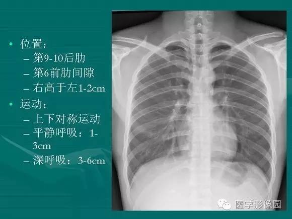 【PPT】膈肌膨出症影像学表现