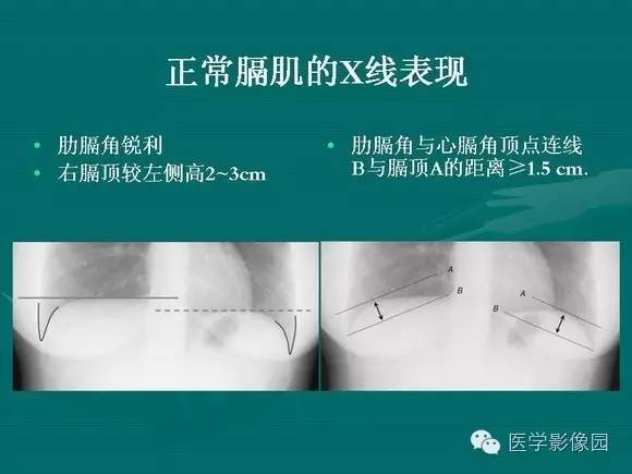 【PPT】膈肌膨出症影像学表现