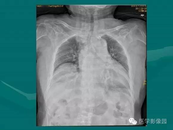 【PPT】膈肌膨出症影像学表现