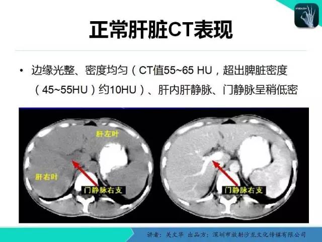 【PPT】精简版肝脏疾病的CT诊断