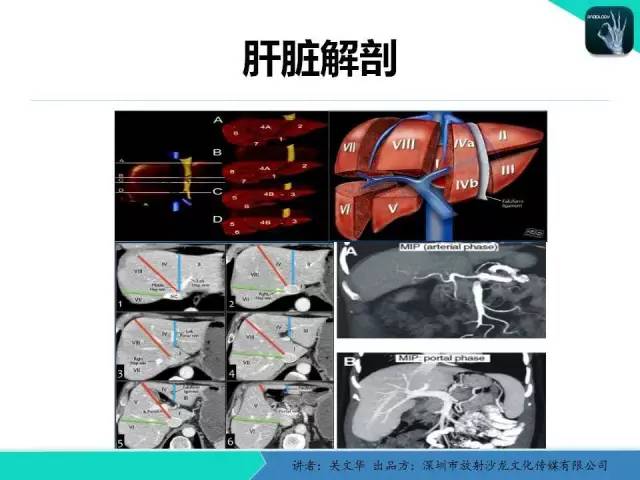 【PPT】精简版肝脏疾病的CT诊断