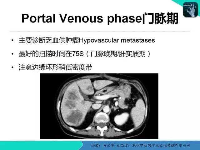 【PPT】精简版肝脏疾病的CT诊断