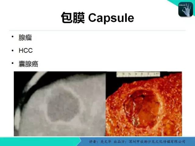 【PPT】精简版肝脏疾病的CT诊断