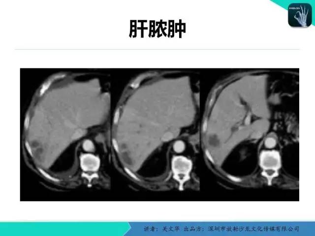 【PPT】精简版肝脏疾病的CT诊断