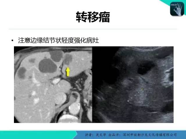 【PPT】精简版肝脏疾病的CT诊断