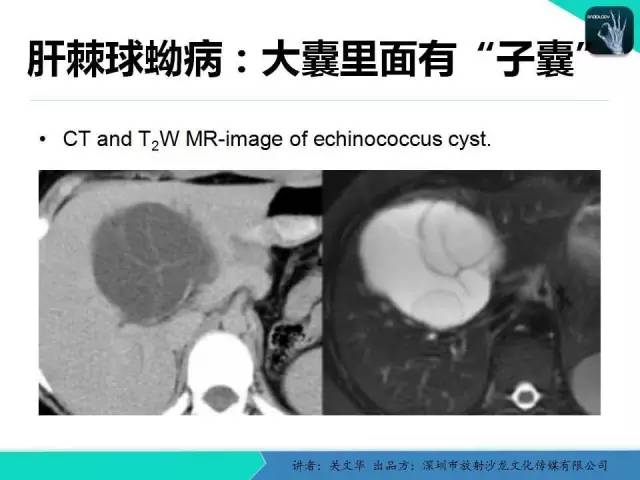 【PPT】精简版肝脏疾病的CT诊断