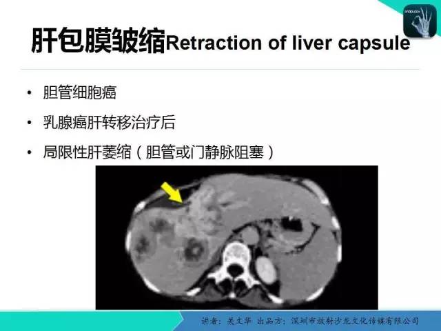 【PPT】精简版肝脏疾病的CT诊断