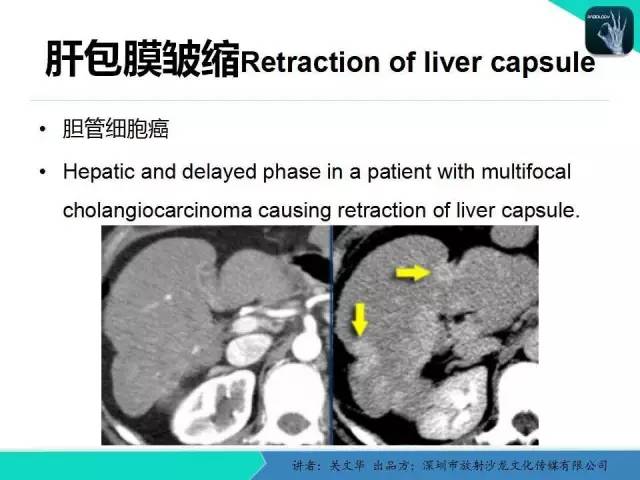 【PPT】精简版肝脏疾病的CT诊断
