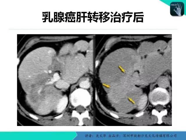【PPT】精简版肝脏疾病的CT诊断