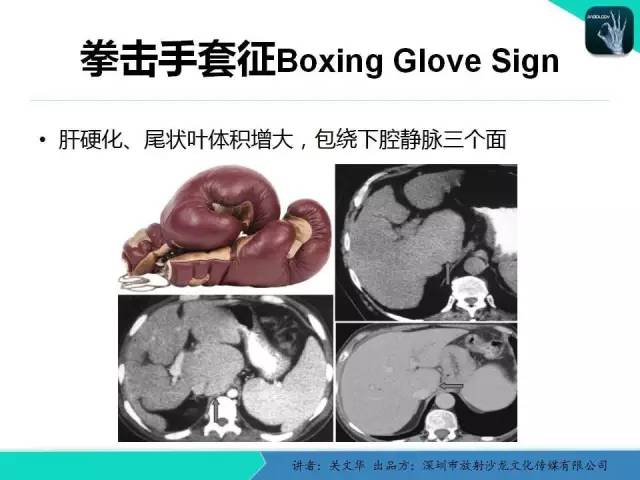【PPT】精简版肝脏疾病的CT诊断