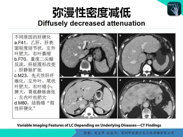 【PPT】精简版肝脏疾病的CT诊断