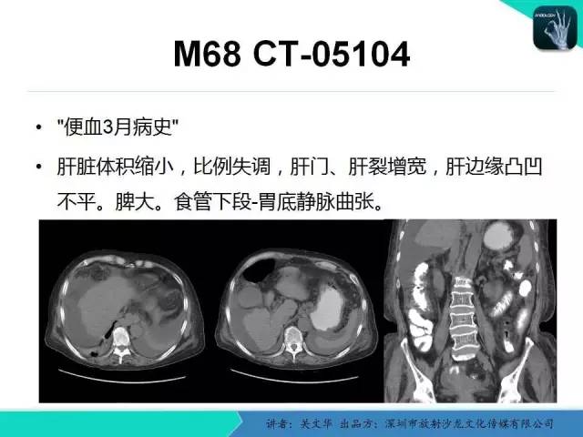 【PPT】精简版肝脏疾病的CT诊断