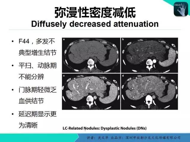 【PPT】精简版肝脏疾病的CT诊断