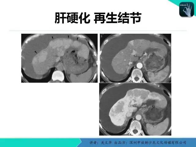 【PPT】精简版肝脏疾病的CT诊断