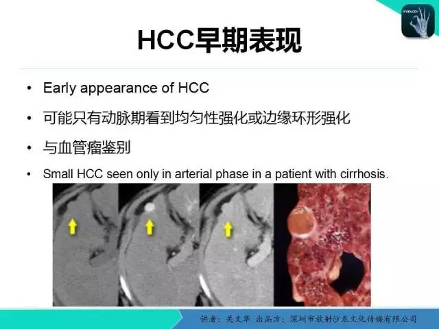 【PPT】精简版肝脏疾病的CT诊断