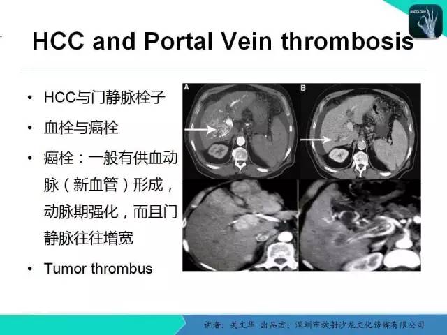 【PPT】精简版肝脏疾病的CT诊断