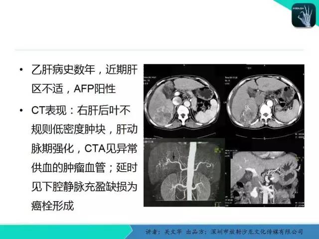 【PPT】精简版肝脏疾病的CT诊断