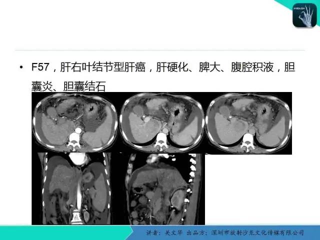 【PPT】精简版肝脏疾病的CT诊断