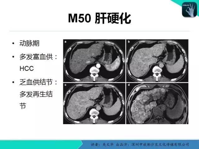 【PPT】精简版肝脏疾病的CT诊断