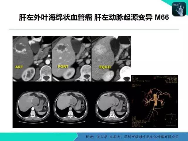 【PPT】精简版肝脏疾病的CT诊断