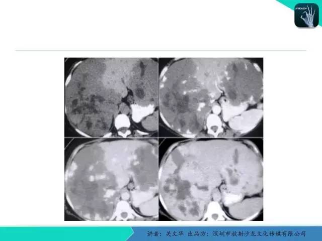 【PPT】精简版肝脏疾病的CT诊断
