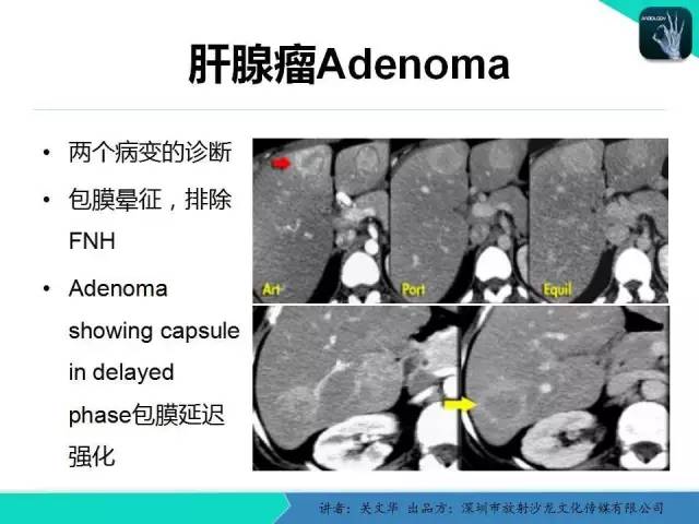 【PPT】精简版肝脏疾病的CT诊断