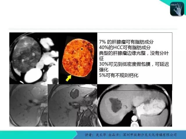 【PPT】精简版肝脏疾病的CT诊断