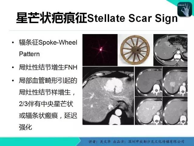 【PPT】精简版肝脏疾病的CT诊断