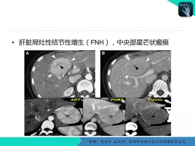 【PPT】精简版肝脏疾病的CT诊断