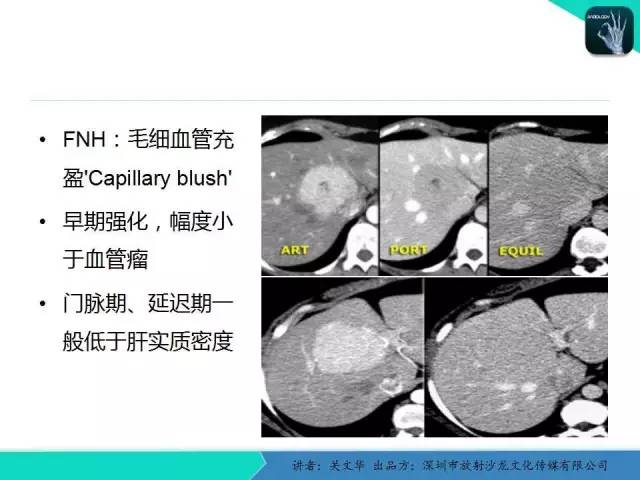 【PPT】精简版肝脏疾病的CT诊断