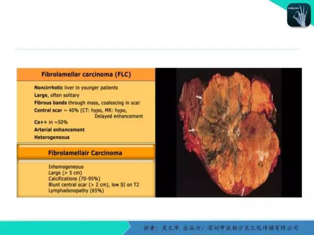 【PPT】精简版肝脏疾病的CT诊断