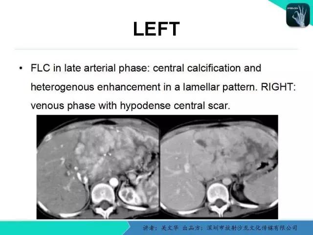 【PPT】精简版肝脏疾病的CT诊断