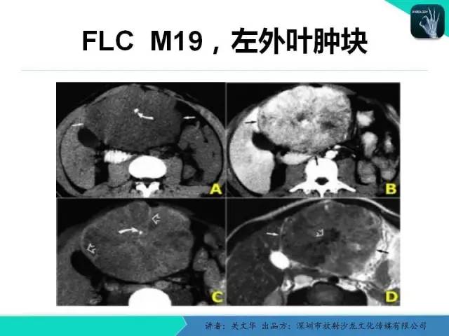 【PPT】精简版肝脏疾病的CT诊断