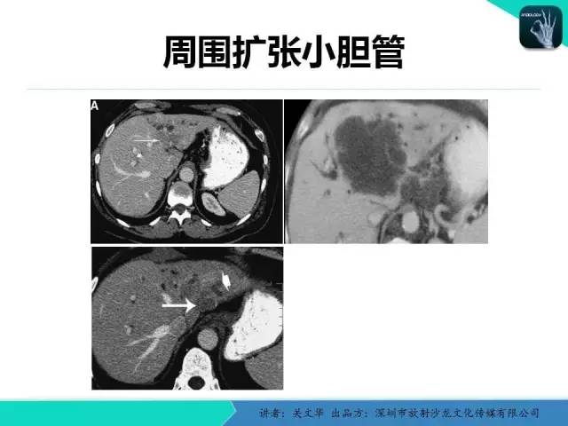 【PPT】精简版肝脏疾病的CT诊断
