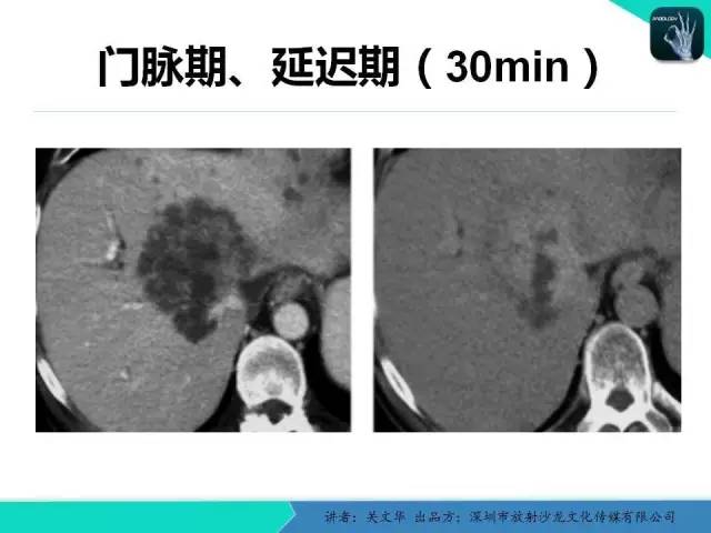 【PPT】精简版肝脏疾病的CT诊断