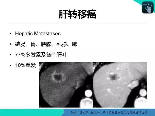 【PPT】精简版肝脏疾病的CT诊断