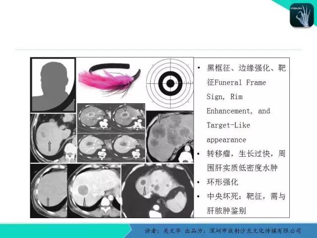 【PPT】精简版肝脏疾病的CT诊断