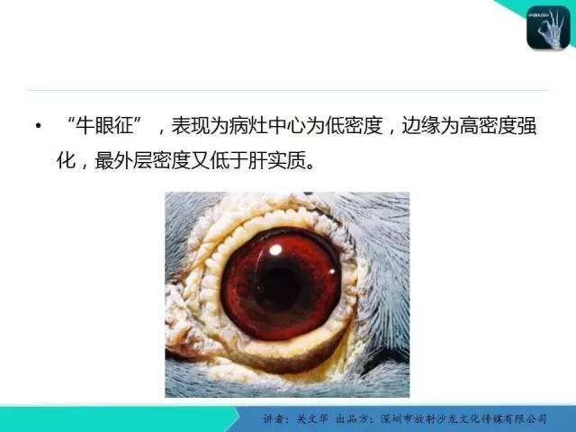 【PPT】精简版肝脏疾病的CT诊断