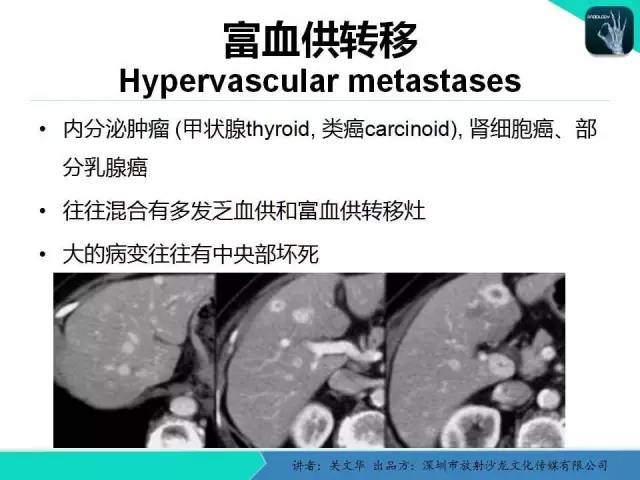 【PPT】精简版肝脏疾病的CT诊断