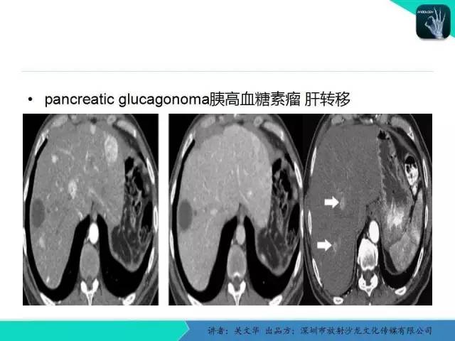 【PPT】精简版肝脏疾病的CT诊断
