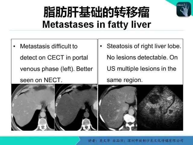 【PPT】精简版肝脏疾病的CT诊断