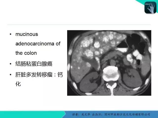 【PPT】精简版肝脏疾病的CT诊断