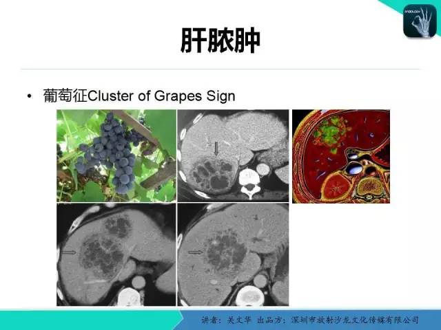 【PPT】精简版肝脏疾病的CT诊断