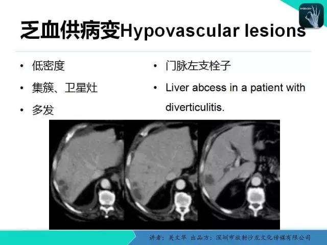 【PPT】精简版肝脏疾病的CT诊断