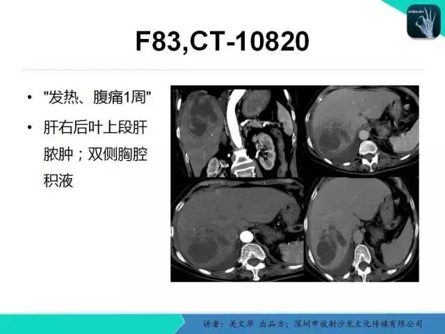 【PPT】精简版肝脏疾病的CT诊断
