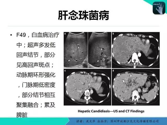 【PPT】精简版肝脏疾病的CT诊断