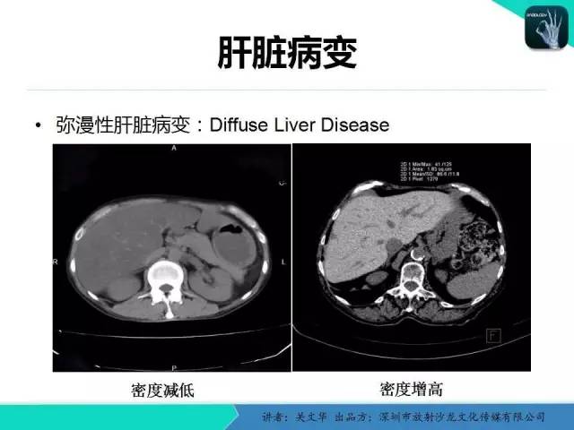 【PPT】精简版肝脏疾病的CT诊断