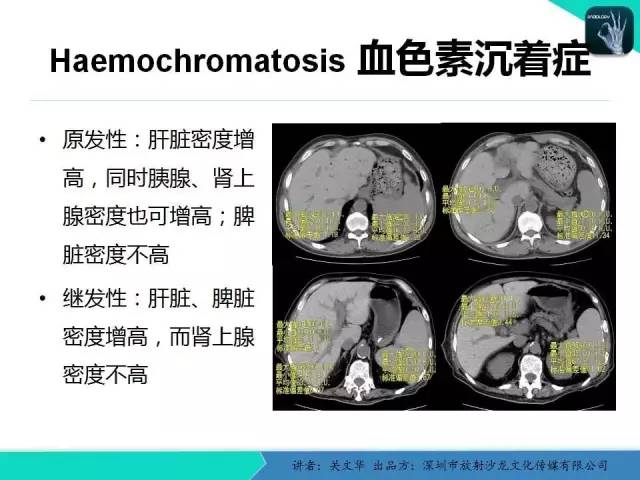 【PPT】精简版肝脏疾病的CT诊断