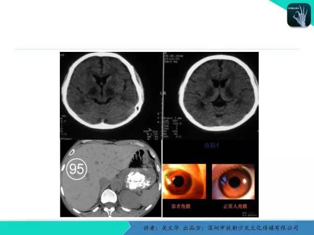 【PPT】精简版肝脏疾病的CT诊断